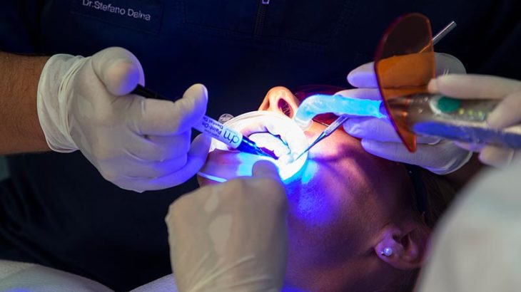 Impianti dentali a carico immediato a Bergamo